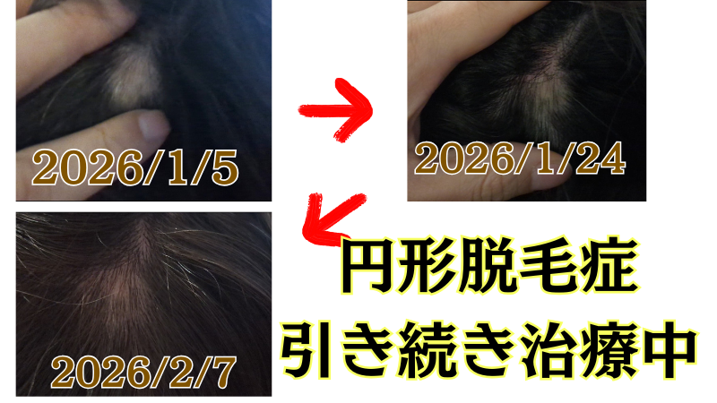 円形脱毛症改善ＣＡＳＥ